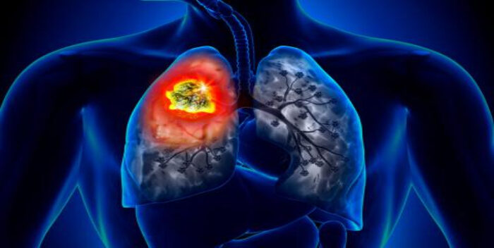Atención tardía de cáncer de pulmón eleva muertes y costos en Latinoamérica