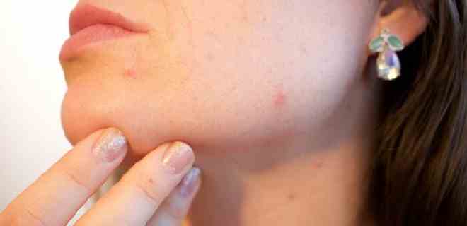 Consejos para evitar la aparición de acné hormonal