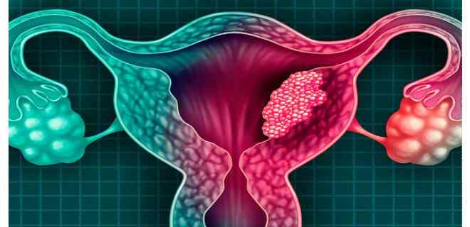 Nueva prueba para detectar el cáncer de útero reduce los falsos positivos